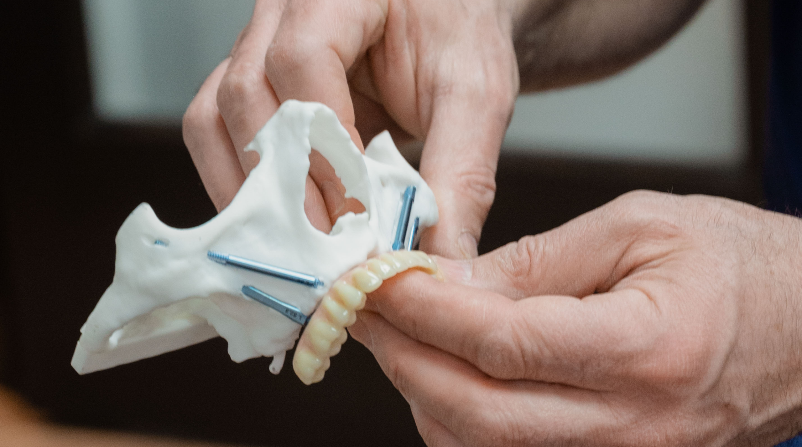 Implants zygomatiques ancrés près de l’os de la pommette en cas de perte osseuse importante de la mâchoire supérieure