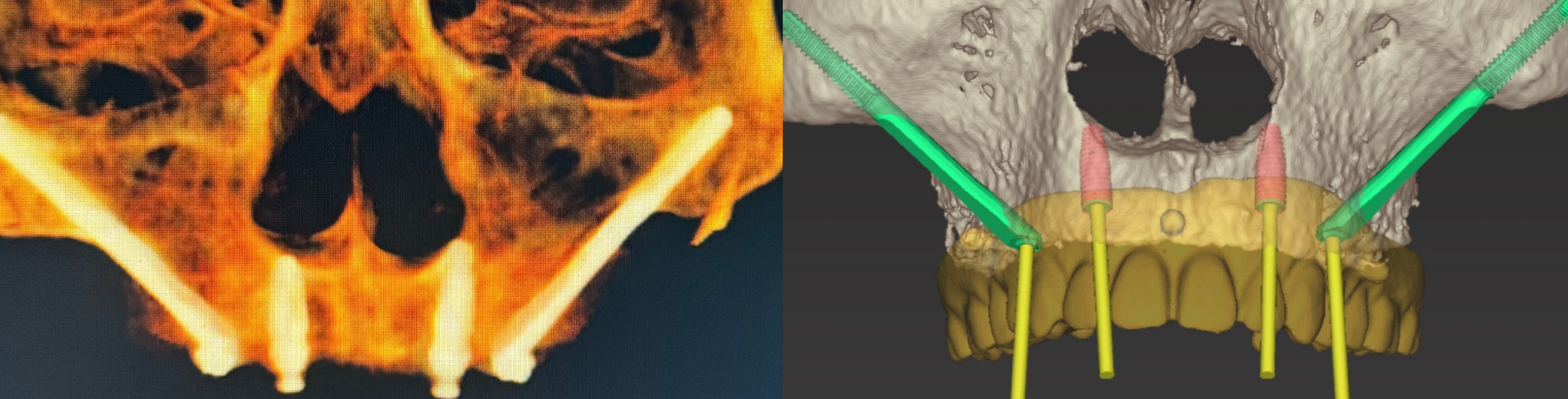 Implants zygomatiques ancrés dans l’os de la pommette en cas de perte osseuse importante de la mâchoire supérieure
