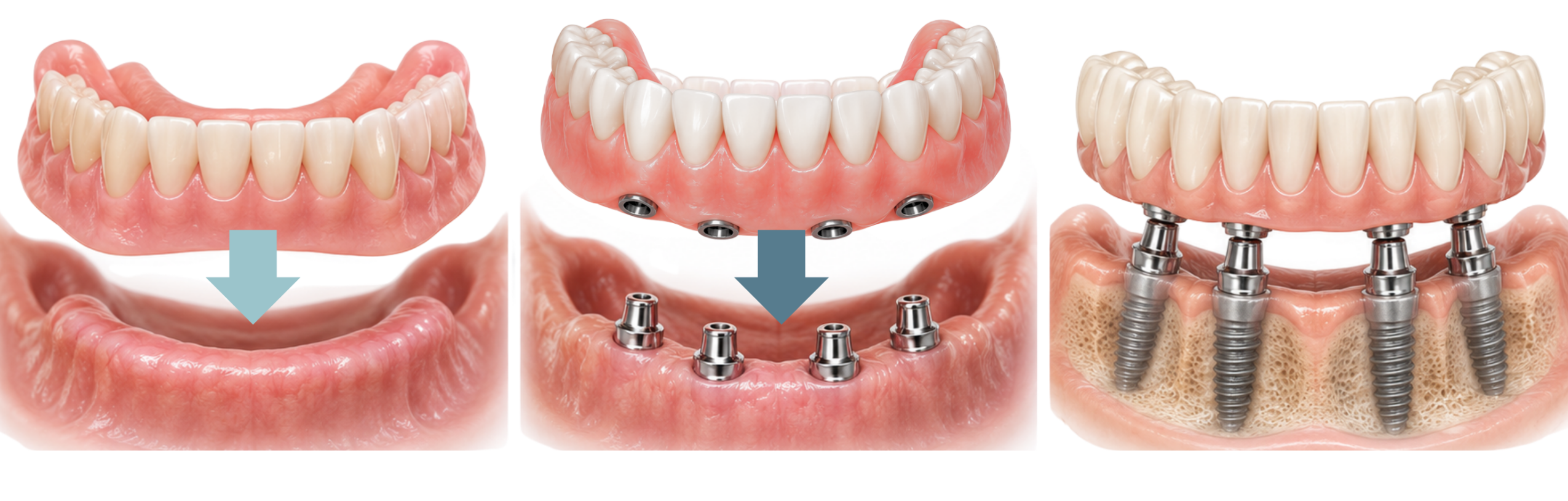 Traditional denture, removable implant denture and fixed full-arch implant restoration.