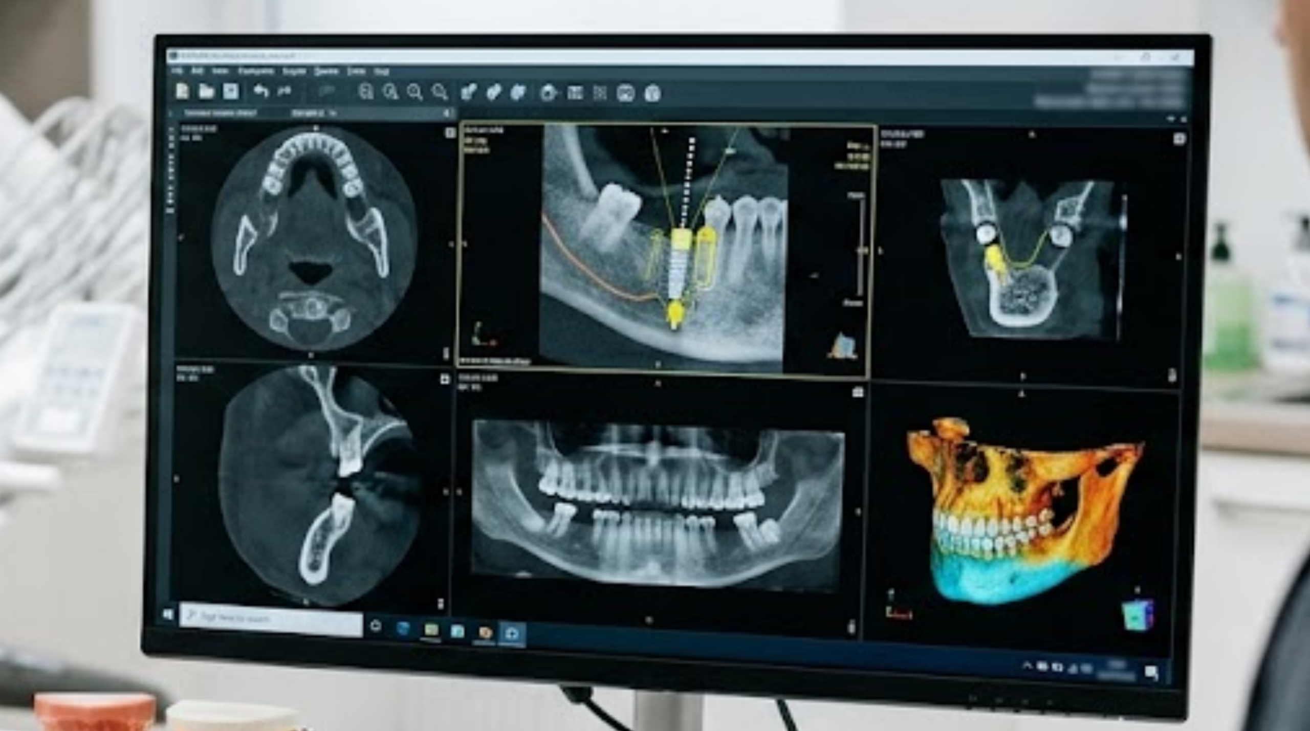 3D dental imaging used to plan immediate dental implant placement.
